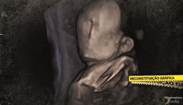 В Португалии родился ребенок без лица